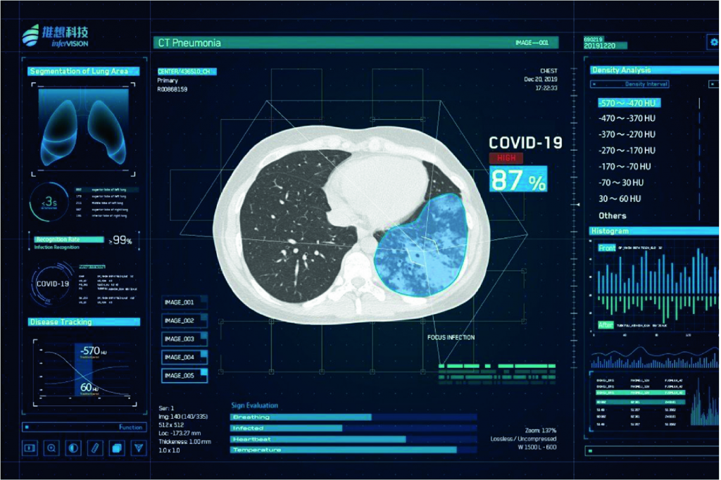 AI imaging database for COVID19 diagnosis provided to UK hospitals