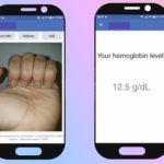 AI app clicks nail selfie to detect blood condition affecting billions